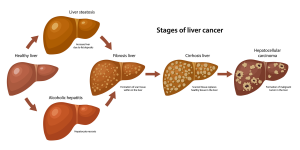 Bile Imbalance Linked to Liver Cancer: New Research Insights