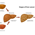 Liver Cancer Bile Imbalance: New Insights from Research